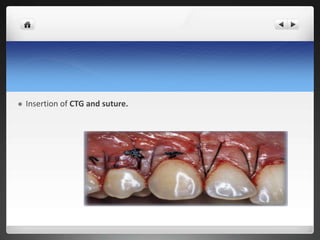  Insertion of CTG and suture.
 