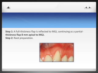 Step 1: A full-thickness flap is reflected to MGJ, continuing as a partial-
thickness flap 8 mm apical to MGJ.
Step 2: Root preparation.
 