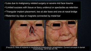 Loss due to malignancy related surgery or severe mid face trauma
Limited success with tissue or bony undercut or spectacles as retention
Triangular implant placement, two at alar base and one at nasal bridge
Retention by clips or magnets connected by metal bar
D’souza D. Role of implants in maxillofacial prosthodontic rehabilitation. Current concepts in dental
implantology. 2015 feb 25:179.
 