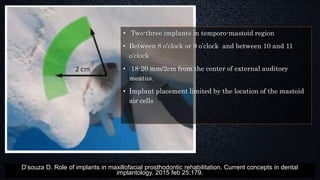 • Two-three implants in temporo-mastoid region
• Between 8 o’clock or 9 o’clock and between 10 and 11
o’clock
• 18-20 mm/2cm from the center of external auditory
meatus.
• Implant placement limited by the location of the mastoid
air cells
D’souza D. Role of implants in maxillofacial prosthodontic rehabilitation. Current concepts in dental
implantology. 2015 feb 25:179.
 