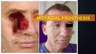 MIDFACIAL PROSTHESIS
 