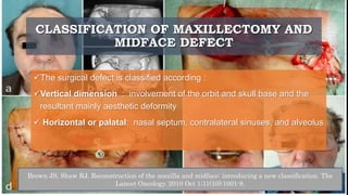 CLASSIFICATION OF MAXILLECTOMY AND
MIDFACE DEFECT
The surgical defect is classified according :
Vertical dimension : involvement of the orbit and skull base and the
resultant mainly aesthetic deformity
 Horizontal or palatal: nasal septum, contralateral sinuses, and alveolus
Brown JS, Shaw RJ. Reconstruction of the maxilla and midface: introducing a new classification. The
Lancet Oncology. 2010 Oct 1;11(10):1001-8.
 