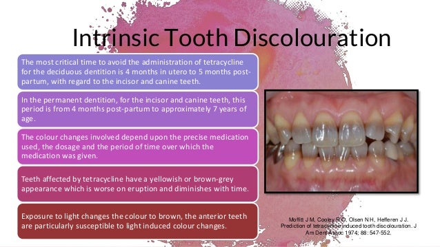 Intrinsic And Extrinsic Discoloration