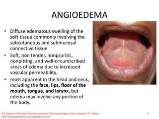 lesions affecting floor of mouth | PPTX