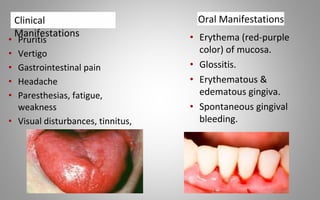 Oral Manifestations
• Erythema (red-purple
color) of mucosa.
• Glossitis.
• Erythematous &
edematous gingiva.
• Spontaneous gingival
bleeding.
• Pruritis
• Vertigo
• Gastrointestinal pain
• Headache
• Paresthesias, fatigue,
weakness
• Visual disturbances, tinnitus,
Clinical
Manifestations
 