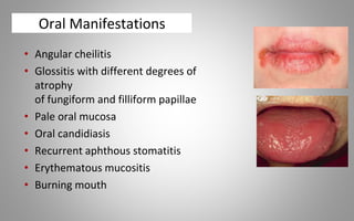 Oral Manifestations
• Angular cheilitis
• Glossitis with different degrees of
atrophy
of fungiform and filliform papillae
• Pale oral mucosa
• Oral candidiasis
• Recurrent aphthous stomatitis
• Erythematous mucositis
• Burning mouth
 