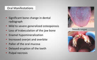 Oral Manifestations
• Significant bone change in dental
radiograph
• Mild to severe generalized osteoporosis
• Loss of trabeculation of the jaw bone
• Enamel hypomineralization
• Increased overjet and overbite
• Pallor of the oral mucosa
• Delayed eruption of the teeth
• Pulpal necrosis
Smooth tongue
 
