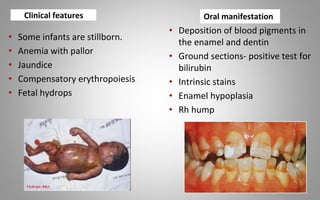 Clinical features
• Some infants are stillborn.
• Anemia with pallor
• Jaundice
• Compensatory erythropoiesis
• Fetal hydrops
• Deposition of blood pigments in
the enamel and dentin
• Ground sections- positive test for
bilirubin
• Intrinsic stains
• Enamel hypoplasia
• Rh hump
Oral manifestation
 