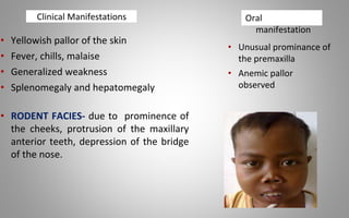 Clinical Manifestations
• Yellowish pallor of the skin
• Fever, chills, malaise
• Generalized weakness
• Splenomegaly and hepatomegaly
• RODENT FACIES- due to prominence of
the cheeks, protrusion of the maxillary
anterior teeth, depression of the bridge
of the nose.
• Unusual prominance of
the premaxilla
• Anemic pallor
observed
Oral
manifestation
 
