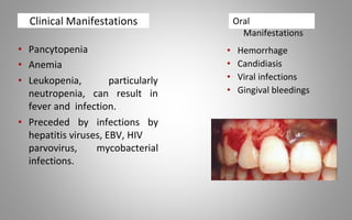 Clinical Manifestations
• Pancytopenia
• Anemia
• Leukopenia, particularly
neutropenia, can result in
fever and infection.
• Preceded by infections by
hepatitis viruses, EBV, HIV
parvovirus, mycobacterial
infections.
• Hemorrhage
• Candidiasis
• Viral infections
• Gingival bleedings
Oral
Manifestations
 