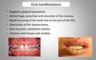 Oral manifestations
• Gingivitis, gingival hyperplasia.
• Hemorrhage, petechiae and ulceration of the mucosa.
• Rapid loosening of the tooth due to necrosis of the PDL.
• Destruction of the alveolar bone.
• Oral mucositis, exfoliative cheilitis.
• Infection with herpes and candida.
 