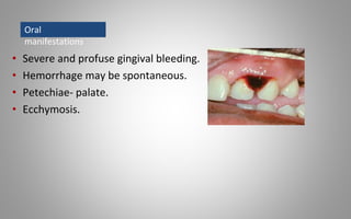 • Severe and profuse gingival bleeding.
• Hemorrhage may be spontaneous.
• Petechiae- palate.
• Ecchymosis.
Oral
manifestations
 