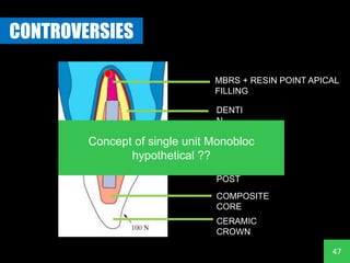 Monoblation Design MONOBLOC IN ENDODONTICS - Root canal filling materials and concept of ...