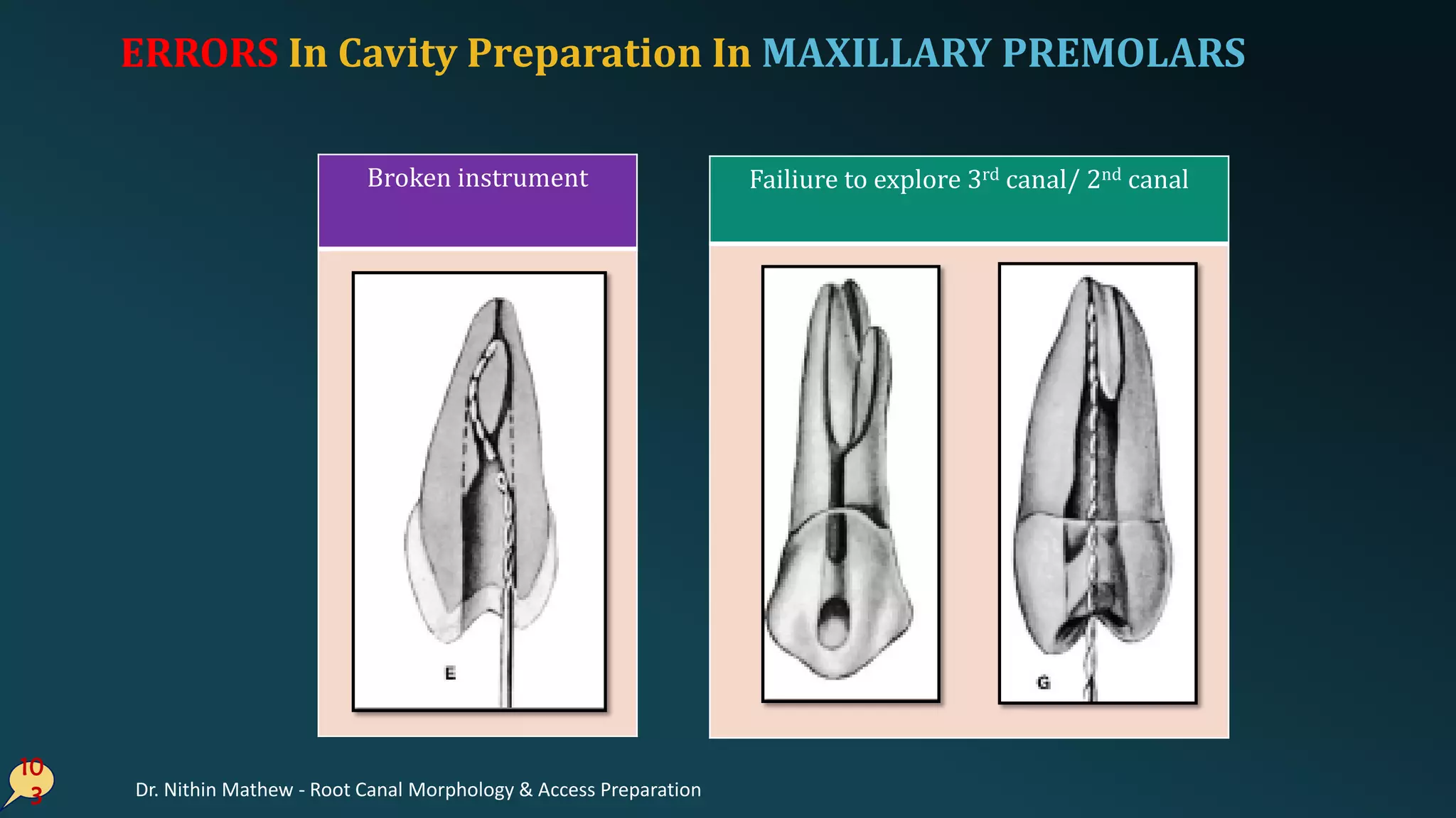 10
3
Failiure to explore 3rd canal/ 2nd canalBroken instrument
ERRORS In Cavity Preparation In MAXILLARY PREMOLARS
Dr. Nithin Mathew - Root Canal Morphology & Access Preparation
 