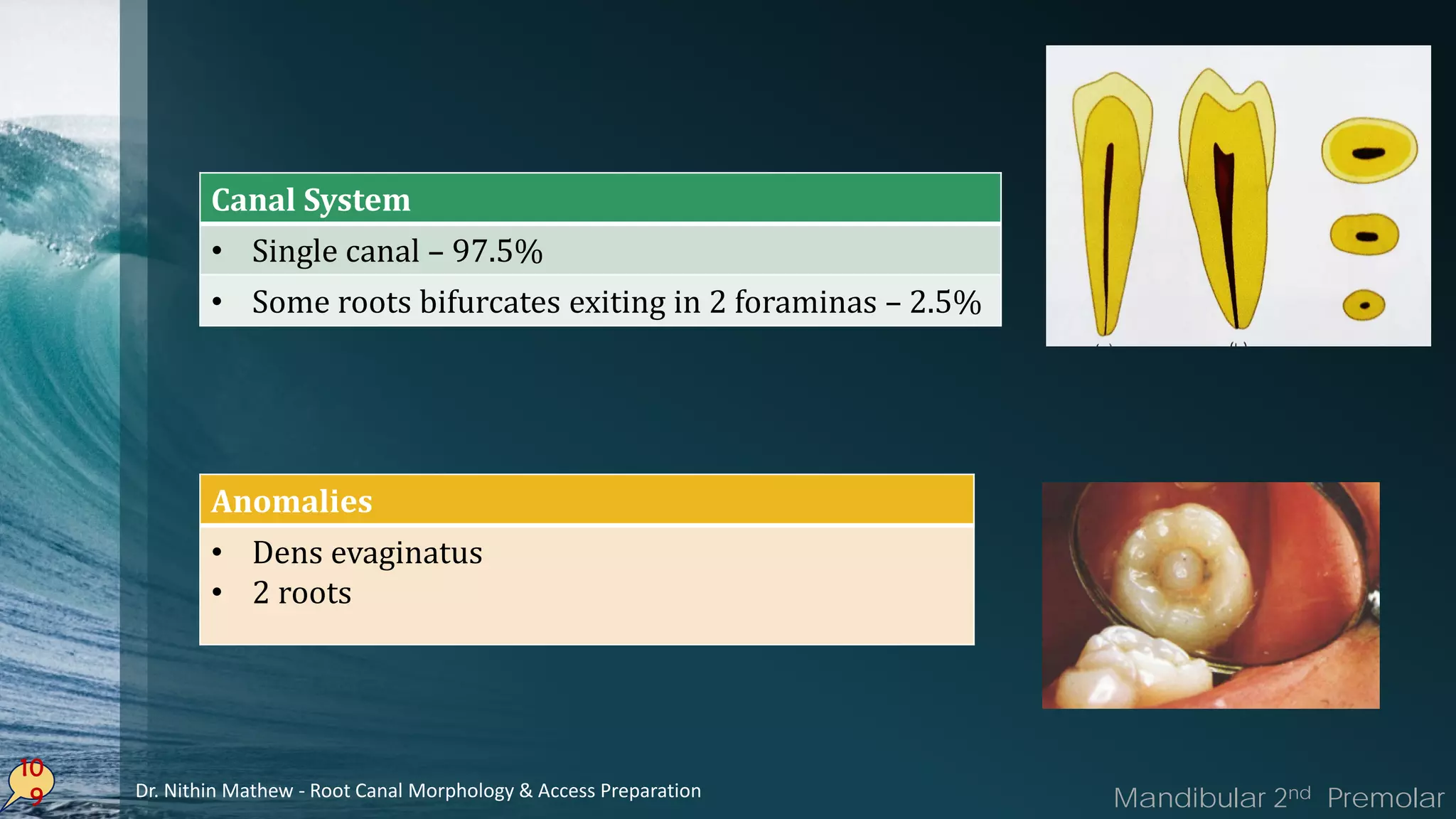 10
9
Anomalies
• Dens evaginatus
• 2 roots
Canal System
• Single canal – 97.5%
• Some roots bifurcates exiting in 2 foraminas – 2.5%
Mandibular 2nd PremolarDr. Nithin Mathew - Root Canal Morphology & Access Preparation
 