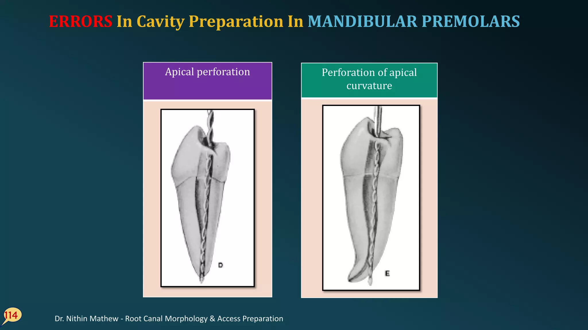 114
Perforation of apical
curvature
Apical perforation
ERRORS In Cavity Preparation In MANDIBULAR PREMOLARS
Dr. Nithin Mathew - Root Canal Morphology & Access Preparation
 