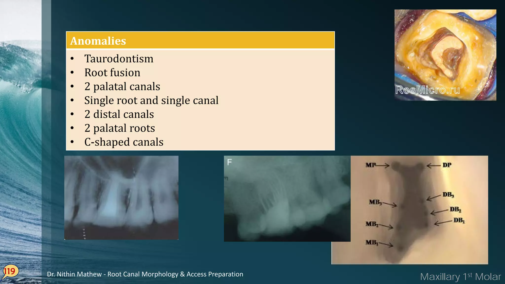 119
Anomalies
• Taurodontism
• Root fusion
• 2 palatal canals
• Single root and single canal
• 2 distal canals
• 2 palatal roots
• C-shaped canals
Maxillary 1st MolarDr. Nithin Mathew - Root Canal Morphology & Access Preparation
 
