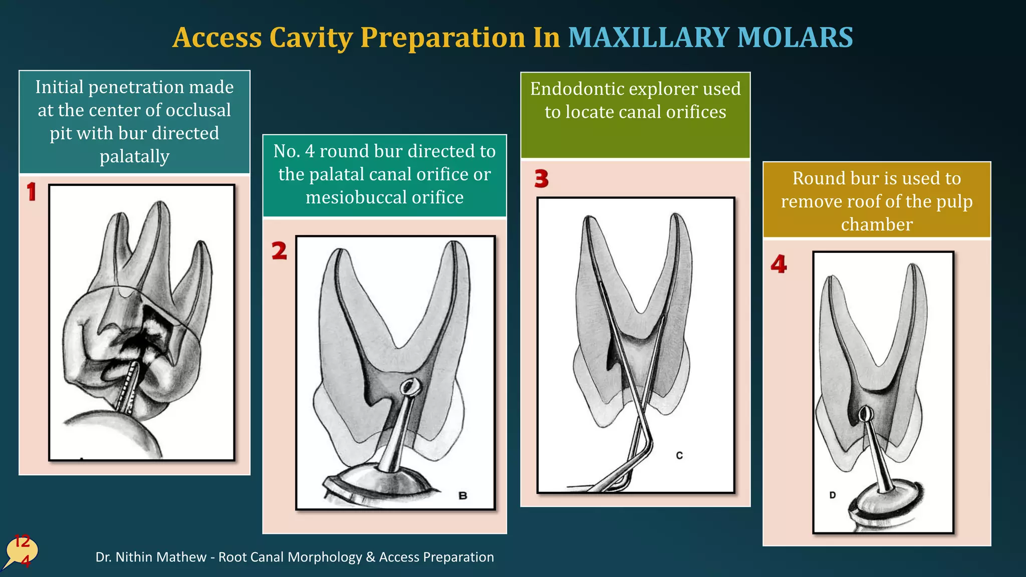 Access Cavity Preparation In MAXILLARY MOLARS
12
4
Initial penetration made
at the center of occlusal
pit with bur directed
palatally No. 4 round bur directed to
the palatal canal orifice or
mesiobuccal orifice
Endodontic explorer used
to locate canal orifices
Round bur is used to
remove roof of the pulp
chamber
Dr. Nithin Mathew - Root Canal Morphology & Access Preparation
 
