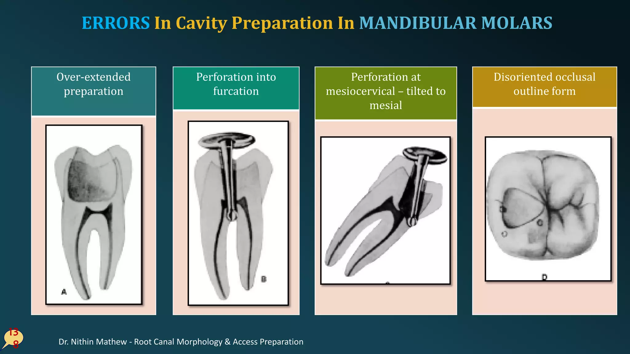 ERRORS In Cavity Preparation In MANDIBULAR MOLARS
13
8
Over-extended
preparation
Perforation into
furcation
Disoriented occlusal
outline form
Perforation at
mesiocervical – tilted to
mesial
Dr. Nithin Mathew - Root Canal Morphology & Access Preparation
 