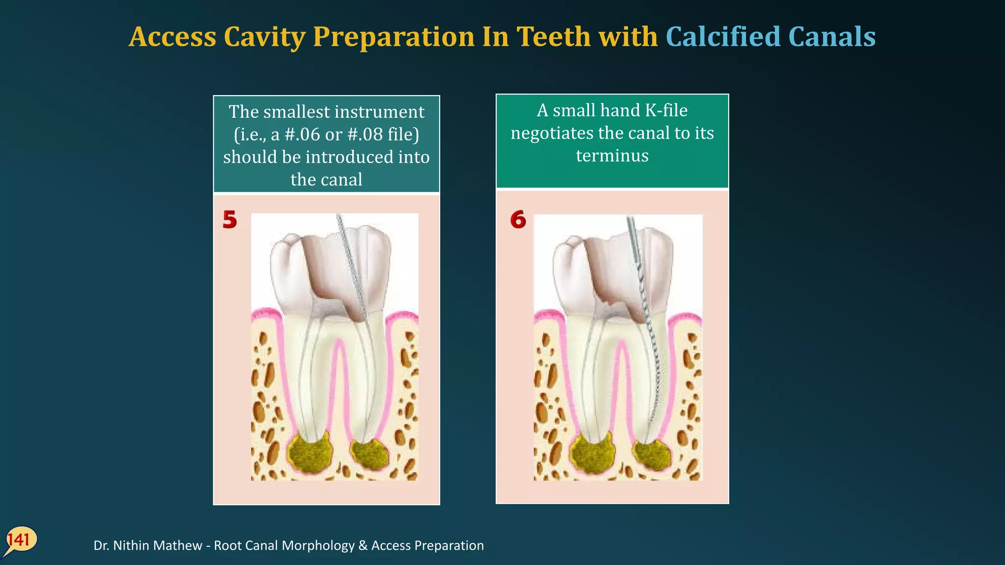 141
The smallest instrument
(i.e., a #.06 or #.08 file)
should be introduced into
the canal
A small hand K-file
negotiates the canal to its
terminus
Access Cavity Preparation In Teeth with Calcified Canals
Dr. Nithin Mathew - Root Canal Morphology & Access Preparation
 