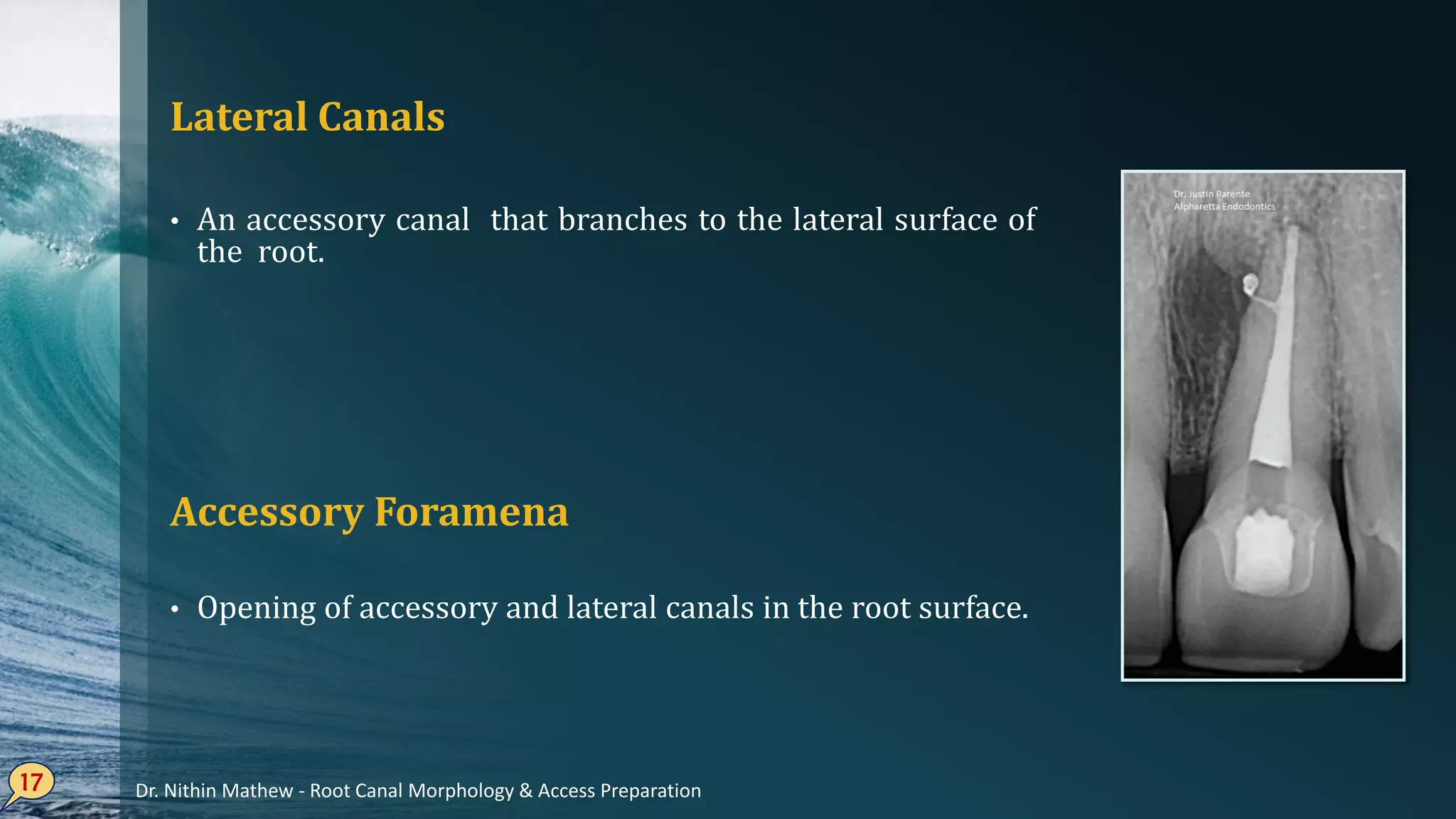 Lateral Canals
• An accessory canal that branches to the lateral surface of
the root.
• Opening of accessory and lateral canals in the root surface.
17
Accessory Foramena
Dr. Nithin Mathew - Root Canal Morphology & Access Preparation
 