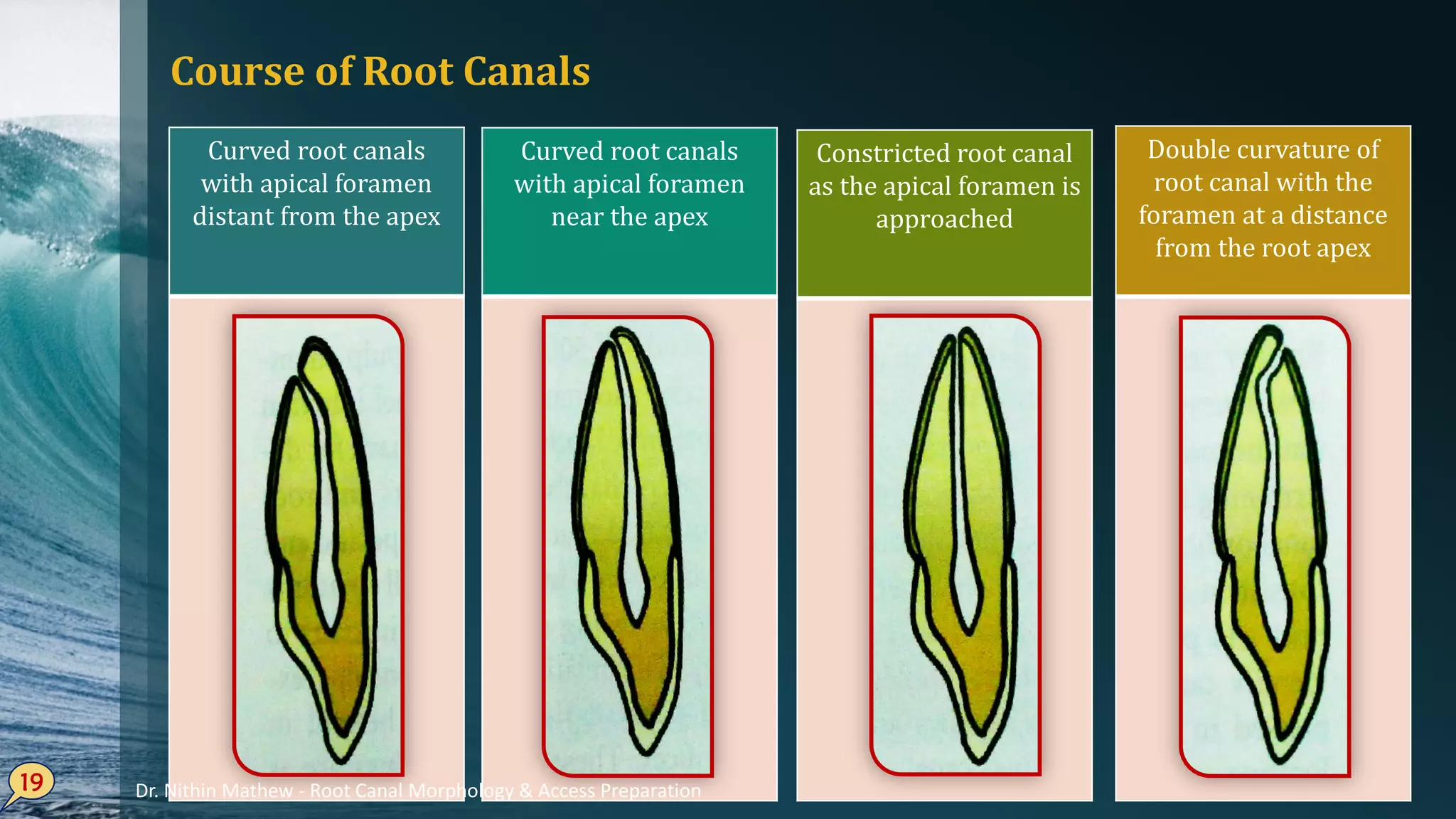 Course of Root Canals
19
Curved root canals
with apical foramen
distant from the apex
Curved root canals
with apical foramen
near the apex
Constricted root canal
as the apical foramen is
approached
Double curvature of
root canal with the
foramen at a distance
from the root apex
Dr. Nithin Mathew - Root Canal Morphology & Access Preparation
 
