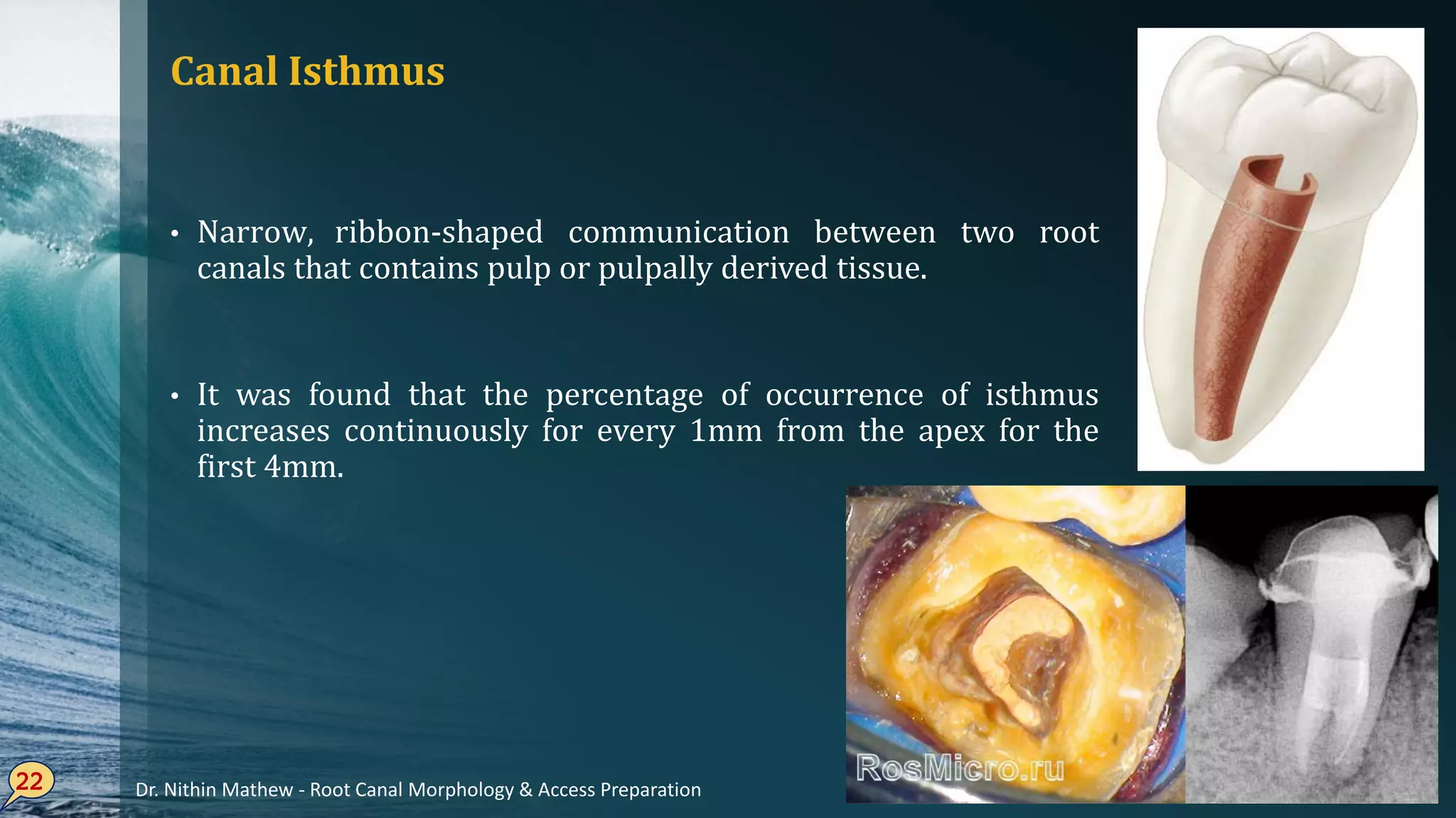 Canal Isthmus
• Narrow, ribbon-shaped communication between two root
canals that contains pulp or pulpally derived tissue.
• It was found that the percentage of occurrence of isthmus
increases continuously for every 1mm from the apex for the
first 4mm.
22 Dr. Nithin Mathew - Root Canal Morphology & Access Preparation
 