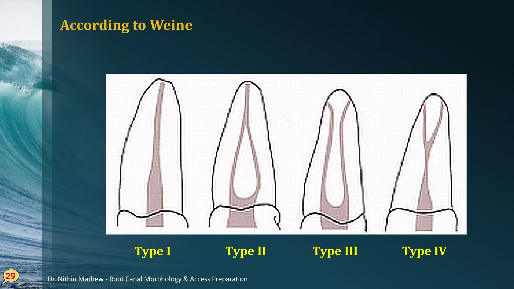 According to Weine
29
Type I Type II Type III Type IV
Dr. Nithin Mathew - Root Canal Morphology & Access Preparation
 