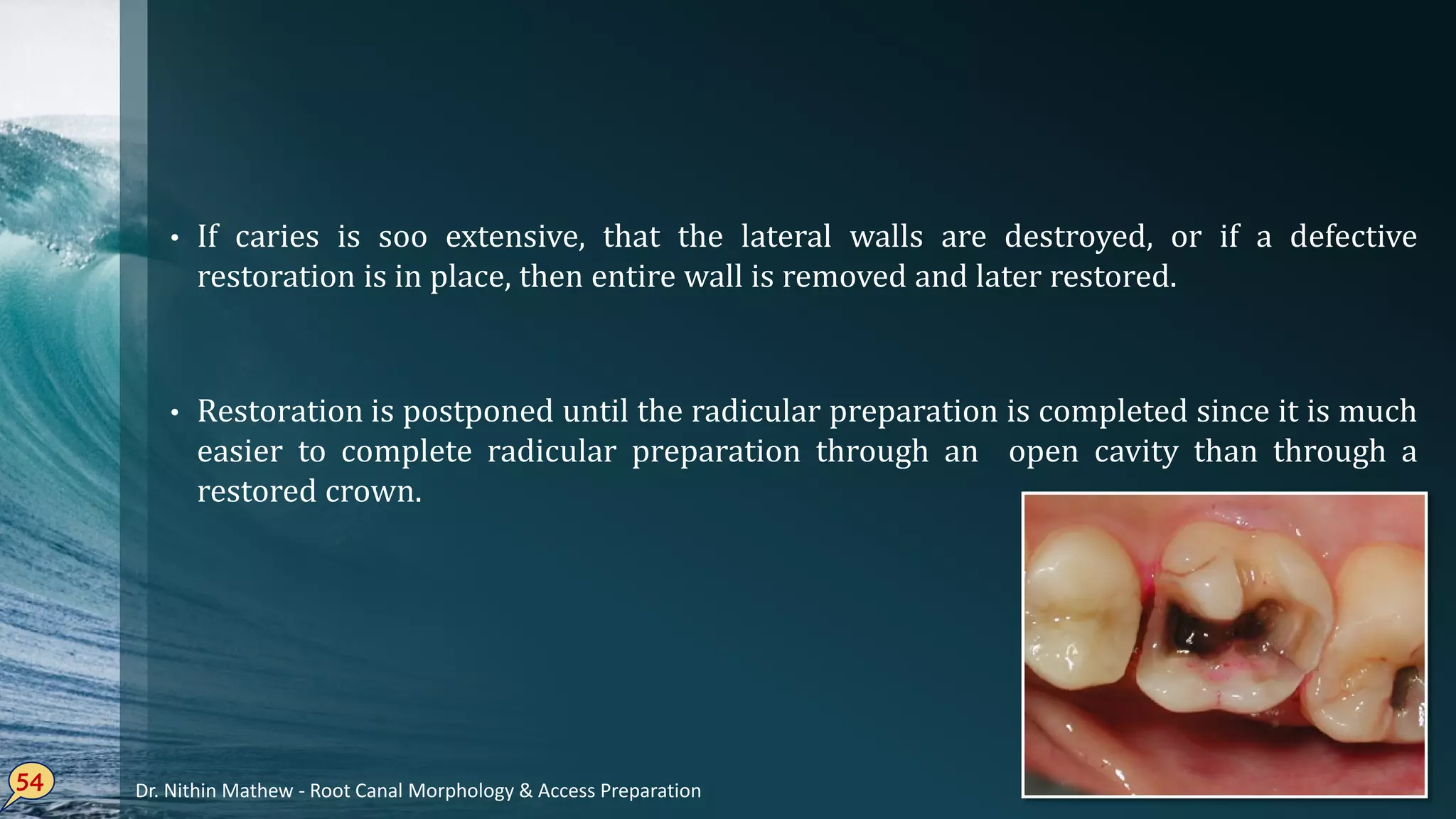 If• caries is soo extensive, that the lateral walls are destroyed, or if a defective
restoration is in place, then entire wall is removed and later restored.
Restoration• is postponed until the radicular preparation is completed since it is much
easier to complete radicular preparation through an open cavity than through a
restored crown.
54 Dr. Nithin Mathew - Root Canal Morphology & Access Preparation
 