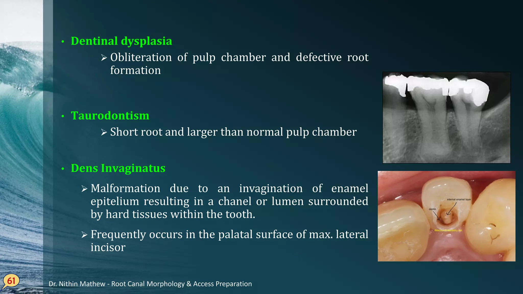 Dentinal• dysplasia
Obliteration of pulp chamber and defective root
formation
Taurodontism•
Short root and larger than normal pulp chamber
Dens• Invaginatus
 Malformation due to an invagination of enamel
epitelium resulting in a chanel or lumen surrounded
by hard tissues within the tooth.
 Frequently occurs in the palatal surface of max. lateral
incisor
61 Dr. Nithin Mathew - Root Canal Morphology & Access Preparation
 