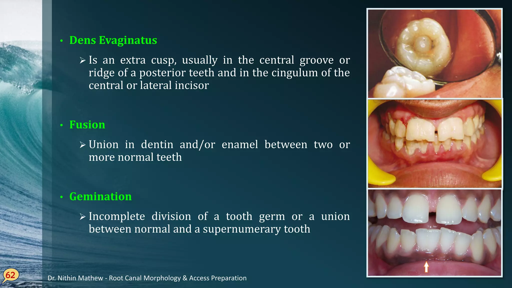 • Dens Evaginatus
 Is an extra cusp, usually in the central groove or
ridge of a posterior teeth and in the cingulum of the
central or lateral incisor
• Fusion
 Union in dentin and/or enamel between two or
more normal teeth
• Gemination
 Incomplete division of a tooth germ or a union
between normal and a supernumerary tooth
62 Dr. Nithin Mathew - Root Canal Morphology & Access Preparation
 