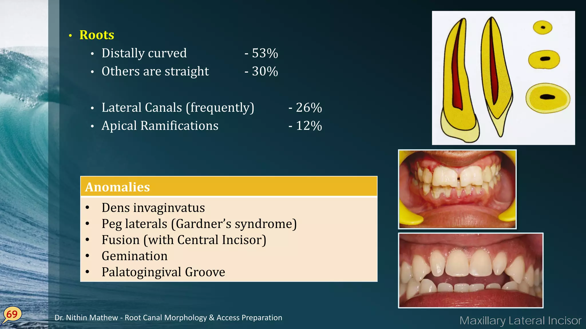 • Roots
• Distally curved - 53%
• Others are straight - 30%
• Lateral Canals (frequently) - 26%
• Apical Ramifications - 12%
69
Anomalies
• Dens invaginvatus
• Peg laterals (Gardner’s syndrome)
• Fusion (with Central Incisor)
• Gemination
• Palatogingival Groove
Maxillary Lateral IncisorDr. Nithin Mathew - Root Canal Morphology & Access Preparation
 