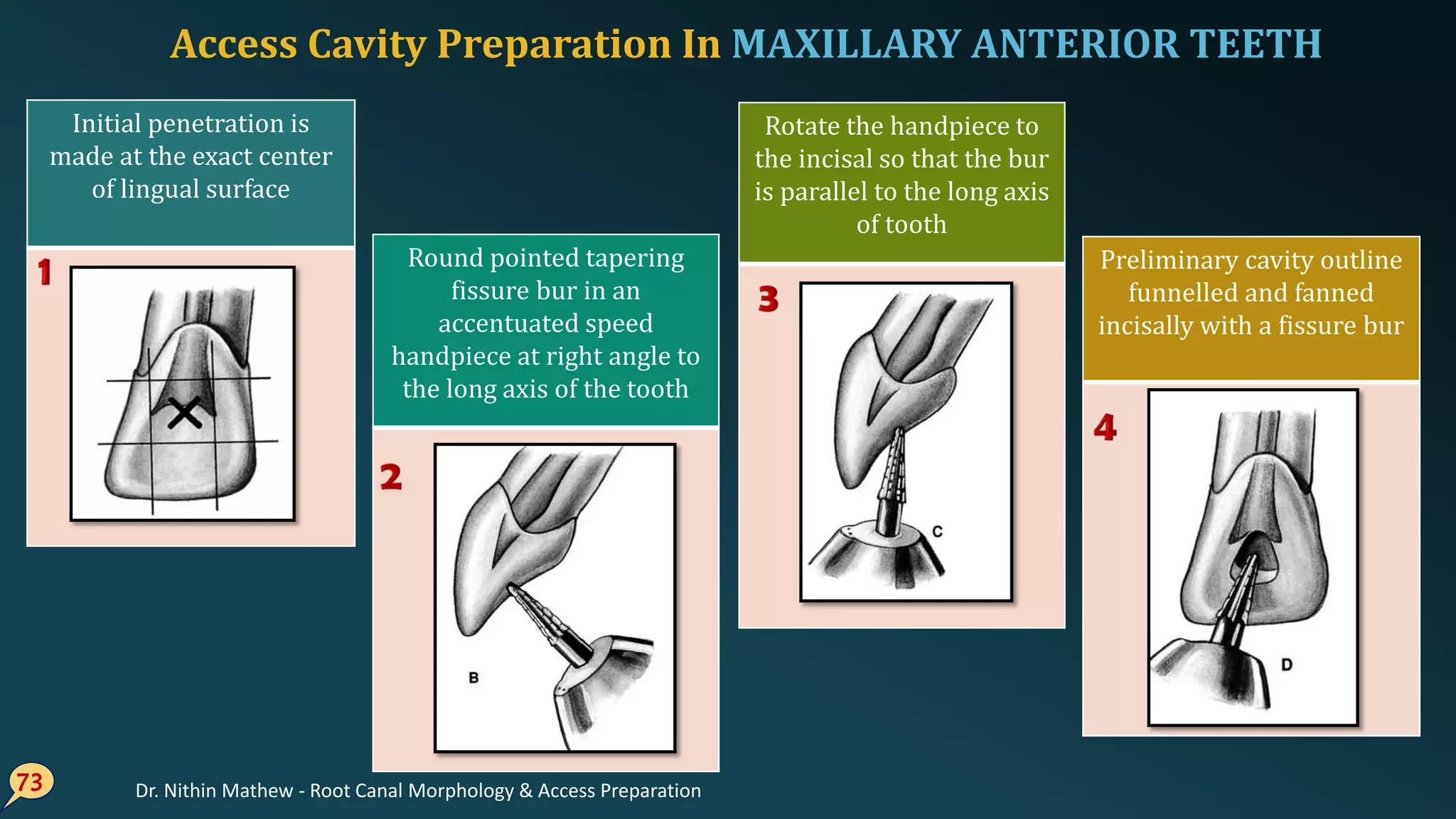 Access Cavity Preparation In MAXILLARY ANTERIOR TEETH
73
Initial penetration is
made at the exact center
of lingual surface
Round pointed tapering
fissure bur in an
accentuated speed
handpiece at right angle to
the long axis of the tooth
Rotate the handpiece to
the incisal so that the bur
is parallel to the long axis
of tooth
Preliminary cavity outline
funnelled and fanned
incisally with a fissure bur
Dr. Nithin Mathew - Root Canal Morphology & Access Preparation
 
