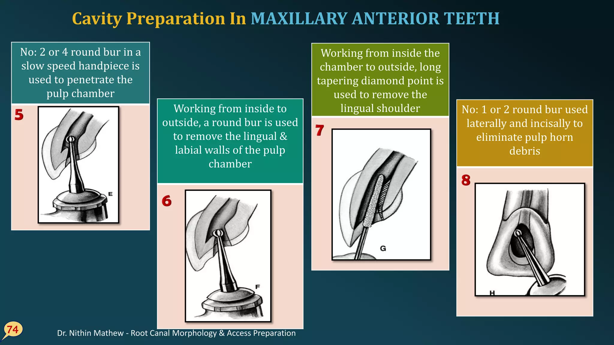 74
No: 2 or 4 round bur in a
slow speed handpiece is
used to penetrate the
pulp chamber
Working from inside to
outside, a round bur is used
to remove the lingual &
labial walls of the pulp
chamber
Working from inside the
chamber to outside, long
tapering diamond point is
used to remove the
lingual shoulder No: 1 or 2 round bur used
laterally and incisally to
eliminate pulp horn
debris
Cavity Preparation In MAXILLARY ANTERIOR TEETH
Dr. Nithin Mathew - Root Canal Morphology & Access Preparation
 
