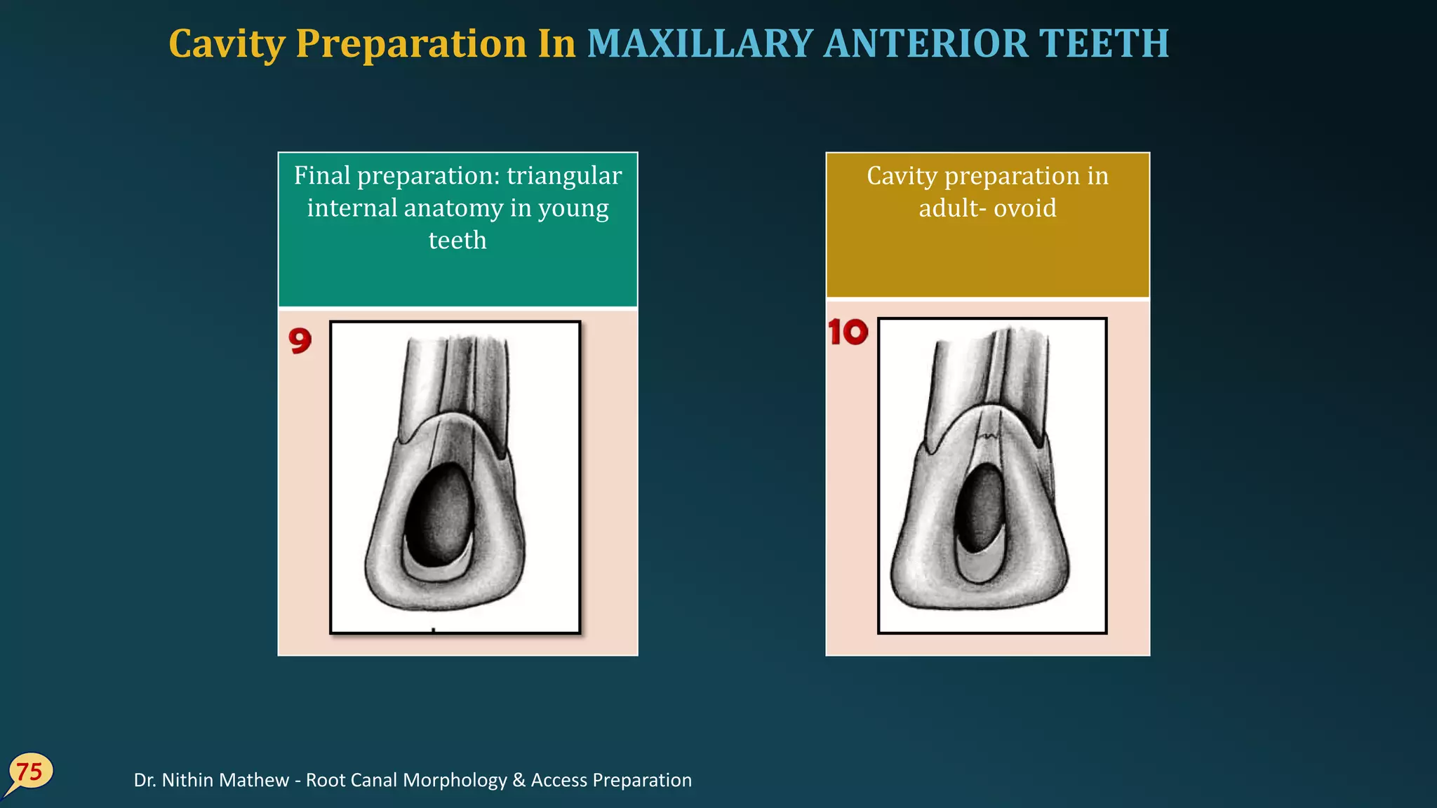 75
Final preparation: triangular
internal anatomy in young
teeth
Cavity preparation in
adult- ovoid
Cavity Preparation In MAXILLARY ANTERIOR TEETH
Dr. Nithin Mathew - Root Canal Morphology & Access Preparation
 