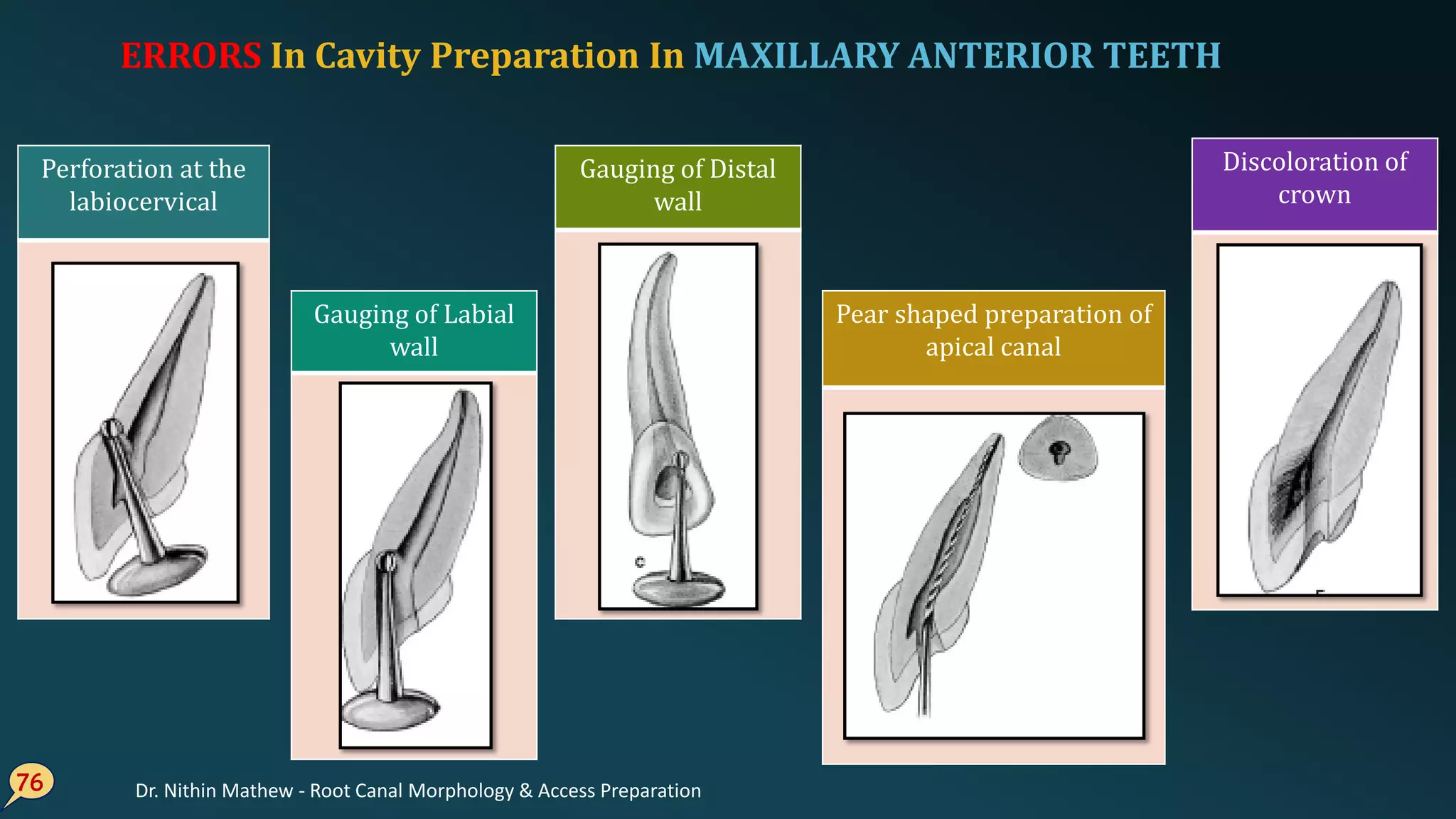 ERRORS In Cavity Preparation In MAXILLARY ANTERIOR TEETH
76
Perforation at the
labiocervical
Gauging of Labial
wall
Pear shaped preparation of
apical canal
Gauging of Distal
wall
Discoloration of
crown
Dr. Nithin Mathew - Root Canal Morphology & Access Preparation
 