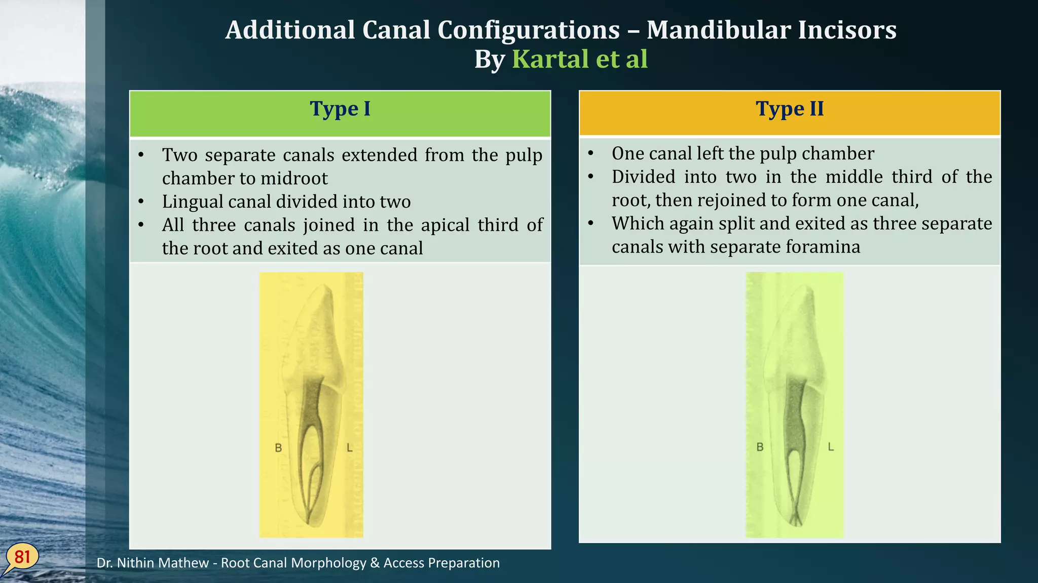 Additional Canal Configurations – Mandibular Incisors
By Kartal et al
81
Type I
• Two separate canals extended from the pulp
chamber to midroot
• Lingual canal divided into two
• All three canals joined in the apical third of
the root and exited as one canal
Type II
• One canal left the pulp chamber
• Divided into two in the middle third of the
root, then rejoined to form one canal,
• Which again split and exited as three separate
canals with separate foramina
Dr. Nithin Mathew - Root Canal Morphology & Access Preparation
 