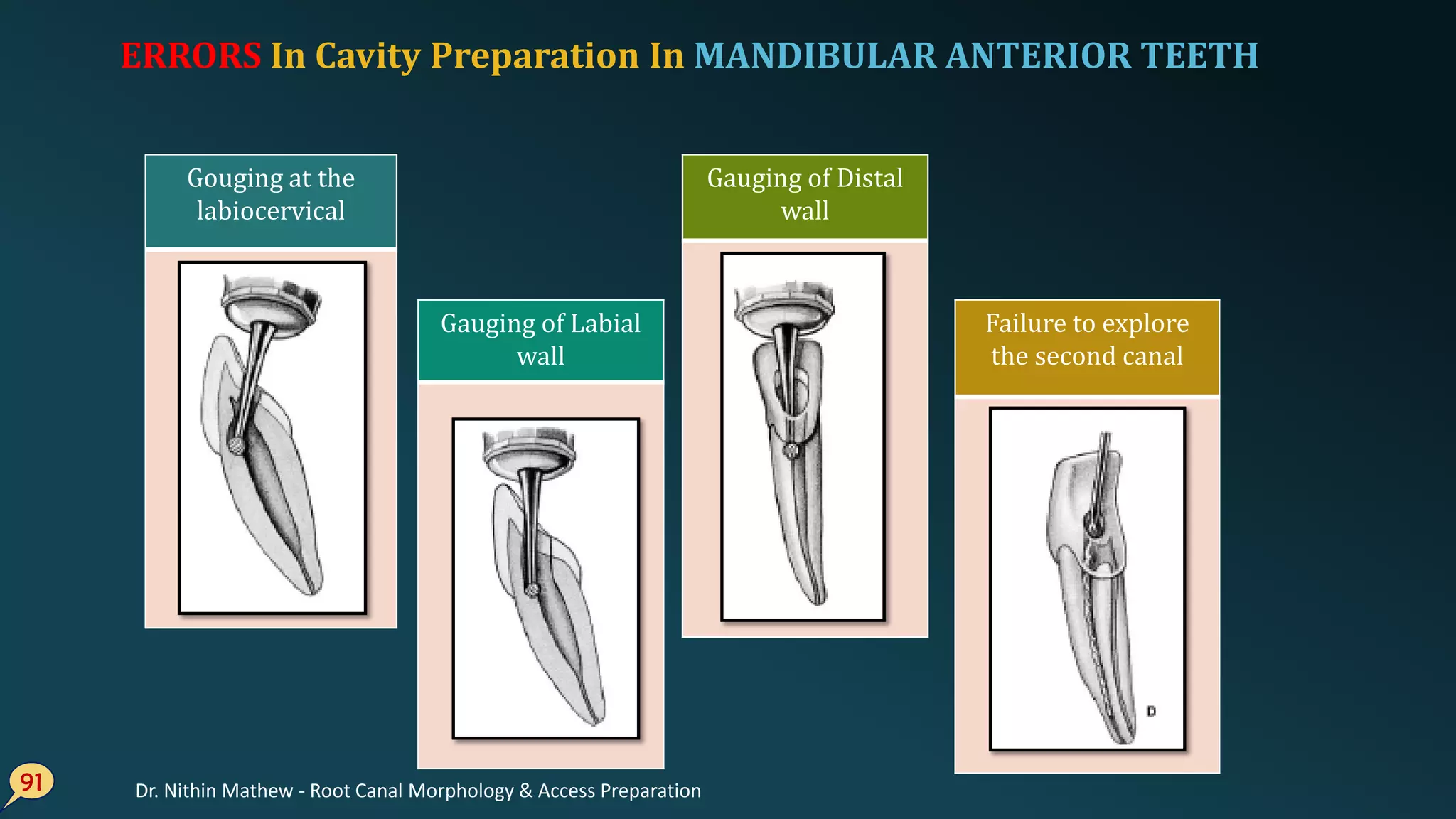 ERRORS In Cavity Preparation In MANDIBULAR ANTERIOR TEETH
91
Gouging at the
labiocervical
Gauging of Labial
wall
Failure to explore
the second canal
Gauging of Distal
wall
Dr. Nithin Mathew - Root Canal Morphology & Access Preparation
 
