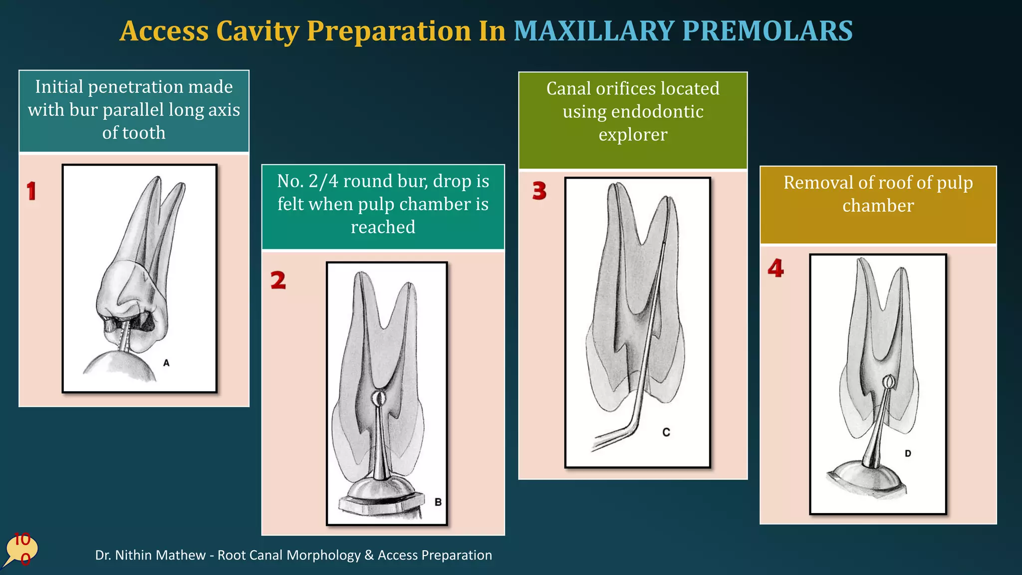 Access Cavity Preparation In MAXILLARY PREMOLARS
10
0
Initial penetration made
with bur parallel long axis
of tooth
No. 2/4 round bur, drop is
felt when pulp chamber is
reached
Canal orifices located
using endodontic
explorer
Removal of roof of pulp
chamber
Dr. Nithin Mathew - Root Canal Morphology & Access Preparation
 