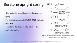 Mini Spring Uprighting Spring Comprehensive Guide to Orthodontic Molar Uprighting Techniques and ...