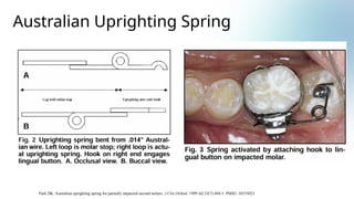 Mini Spring Uprighting Spring Comprehensive Guide to Orthodontic Molar Uprighting Techniques and ...