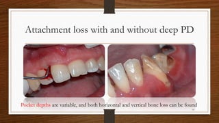 Attachment loss with and without deep PD
Pocket depths are variable, and both horizontal and vertical bone loss can be found
14
 