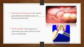 • Furcation involvement in the molars
are common in advance cases of
chronic periodontitis.
• Tooth mobility often appears in
advanced cases when bone loss has
been considerable.
15
 
