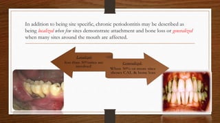 In addition to being site specific, chronic periodontitis may be described as
being localized when few sites demonstrate attachment and bone loss or generalized
when many sites around the mouth are affected.
18
 