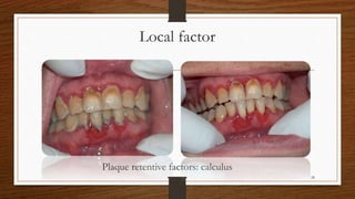 Local factor
Plaque retentive factors: calculus
28
 