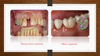 Trauma from occlusion Micro-organism
30
 