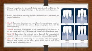 • Gingival recession is recorded during periodontal probing as the
distance of the free gingival margin to the cemento-enamel junction .
• Miller’s classification is widely accepted classiﬁcation to determine the
gingival recession:
• Class I: Recession that does not extend to the mucogingival junction
and is not associated with loss of bone or gingival tissue in the
interdental area;
• Class II: Recession that extends to the mucogingival junction and is
not associated with loss of bone or soft tissue in the interdental area;
• Class III: Recession that extends to or beyond the mucogingival
junction with loss of bone or soft tissue in the interdental area; and
• Class IV :Recession extending to or beyond the mucogingival
junction with severe loss of inter- dental bone and/or soft tissue
and/or severe tooth malposition.
71
 