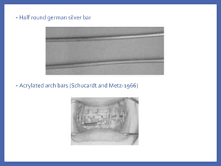 • Half round german silver bar
• Acrylated arch bars (Schucardt and Metz-1966)
 