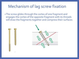 Mechanism of lag screw fixation
•The screw glides through the cortex of one fragment and
engages the cortex of the opposite fragment with its threads
will draw the fragments together and compress their surfaces
 