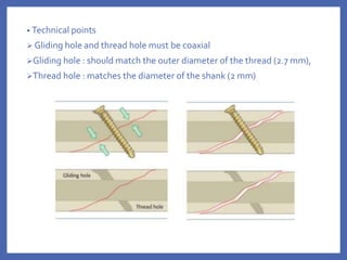 • Technical points
 Gliding hole and thread hole must be coaxial
Gliding hole : should match the outer diameter of the thread (2.7 mm),
Thread hole : matches the diameter of the shank (2 mm)
 